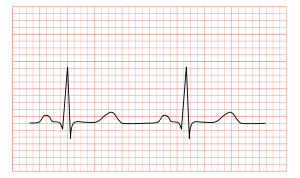 ekg